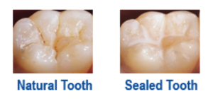 dental sealants